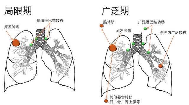 肺癌有什么类型？如何分期？如何分型？-1.png